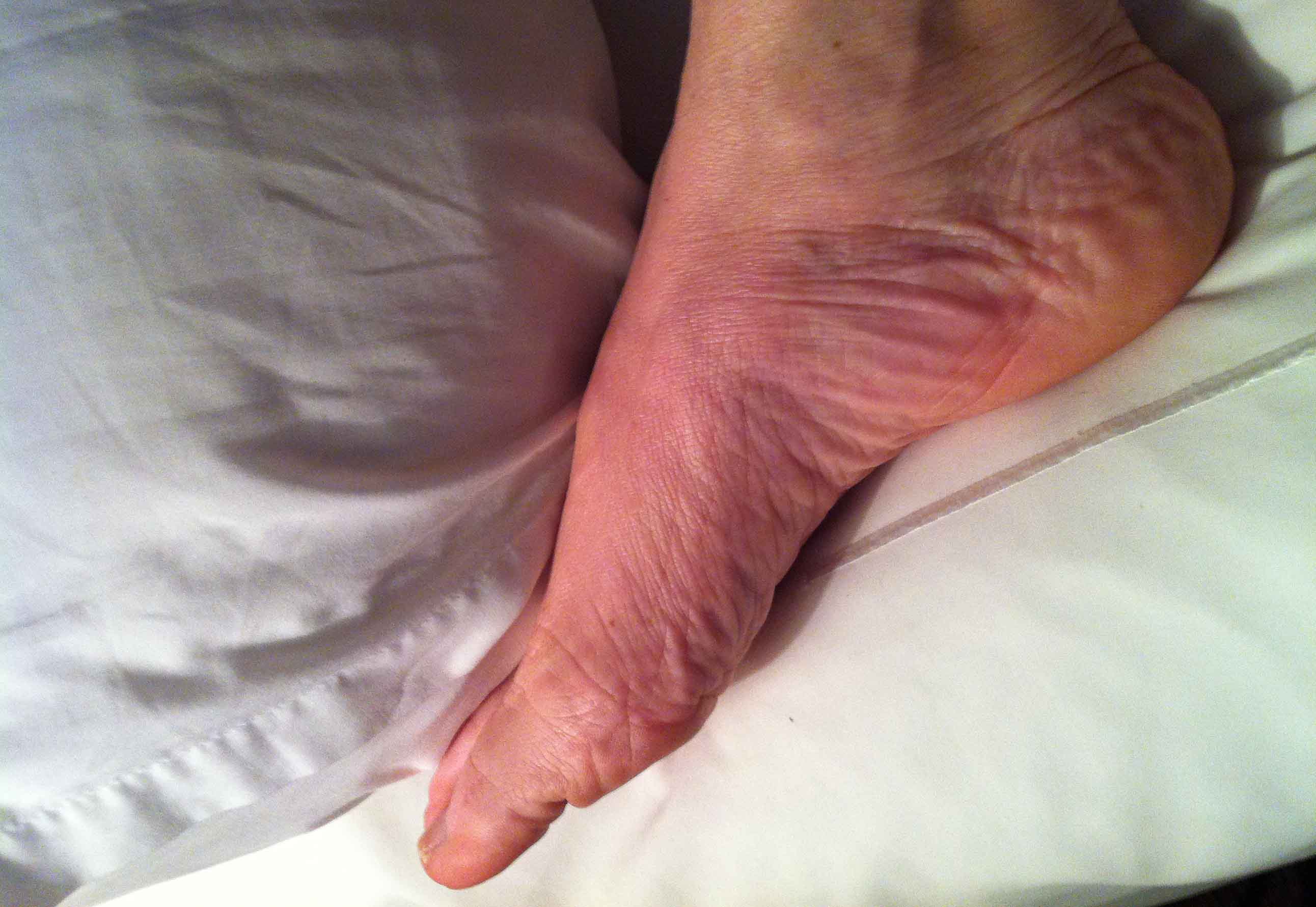 foot rashes that itch